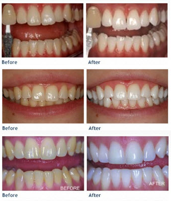KöR® Whitening Burlington, MA