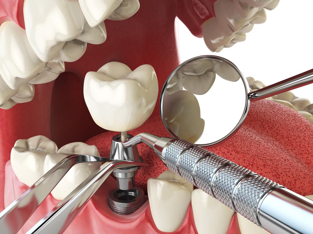 Cosmetic Dental Implant Restoration Burlington, MA